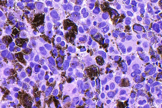 لقاح mRNA لسرطان الجلد ينجح في المرحلة الثالثة وأسهم مودرنا وميرك ترتفع